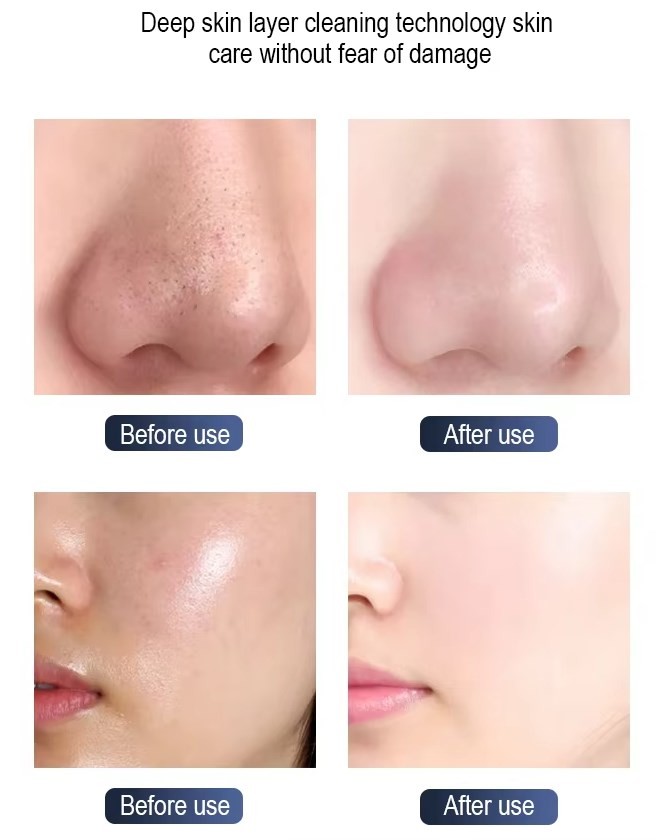 Hydra Dermabrasion Facial Machine Oxygen Facial Beauty Machine For Sales