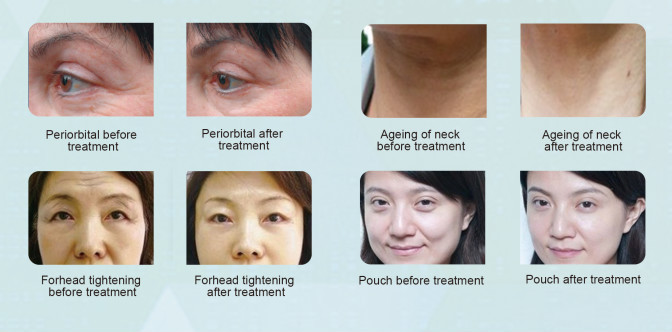 HIFU py for Face Lift Device Vibrating Massage Machine