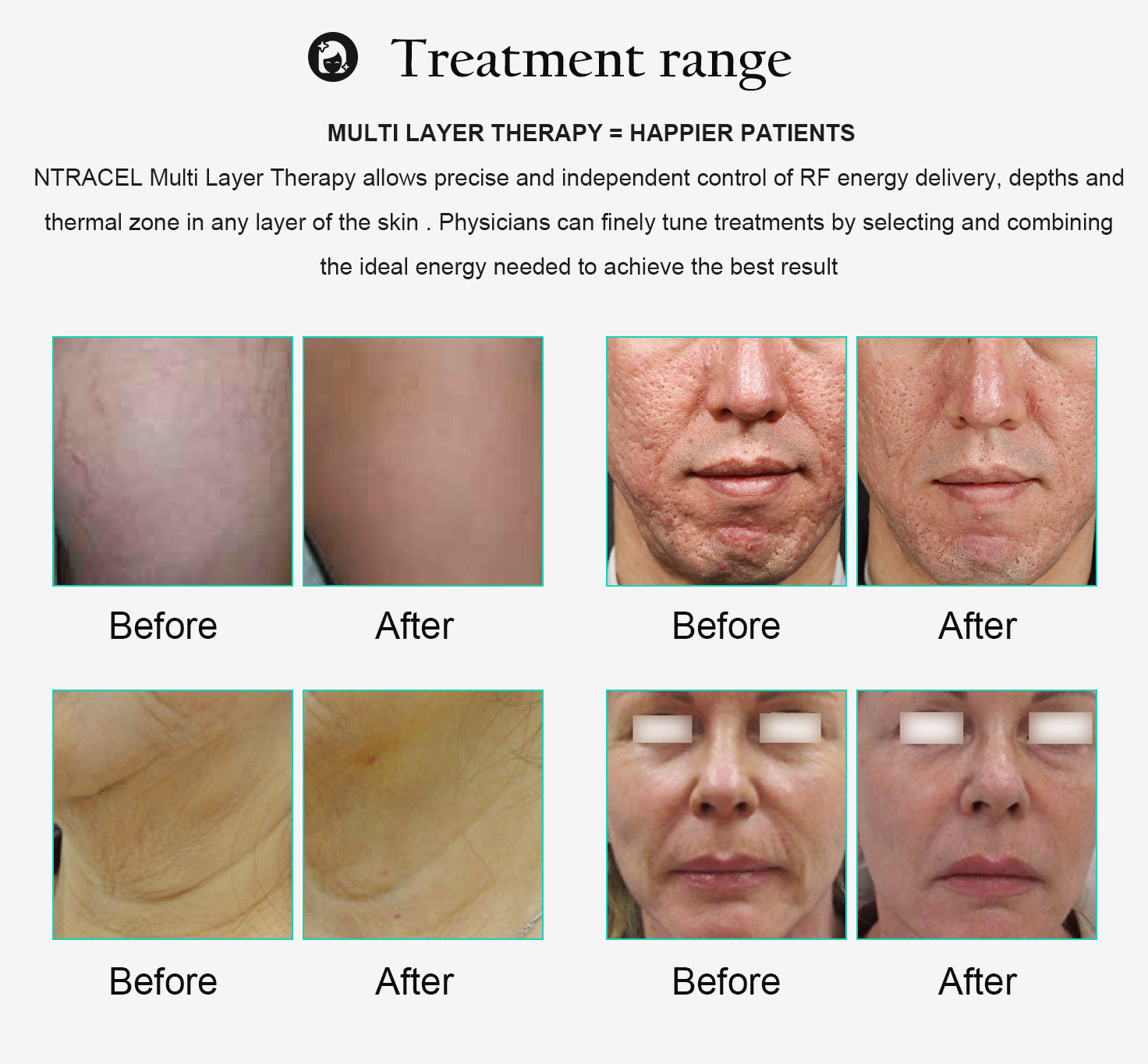Cosmetic Repair Microneedle Radiofrequency Device No Insulation Plating
