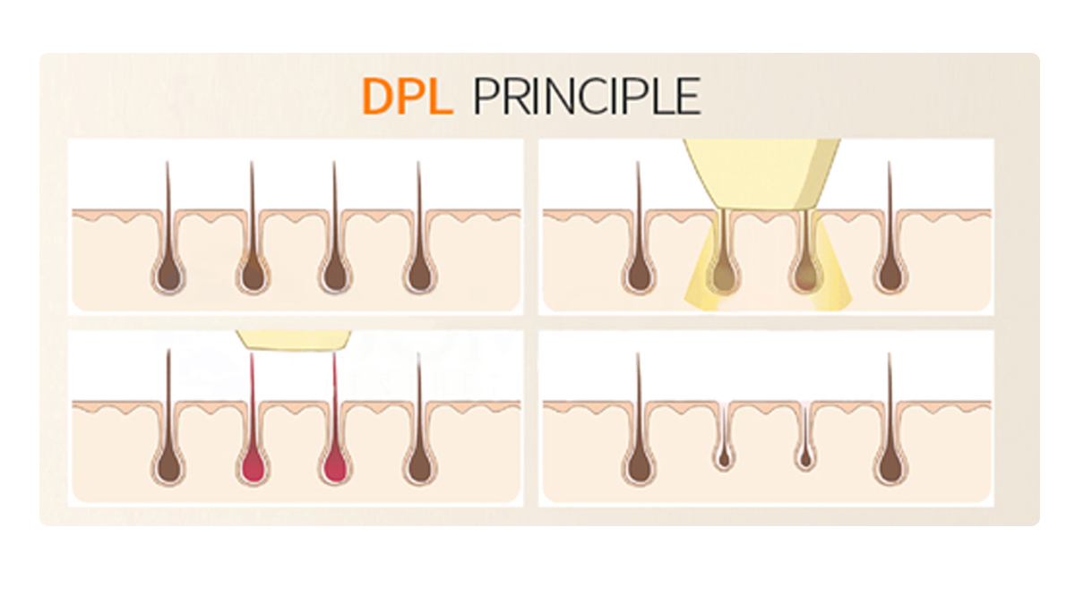 DPL IPL OPT E-Light Permanent Laser Hair Removal Skin Rejuvenation Beauty Machine