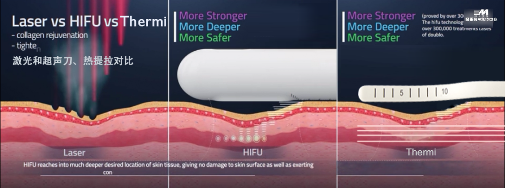 2 in 1 female intimate areal Tigthen RF Radio Frequency Technology Labia Tighten Rejuvenation Device