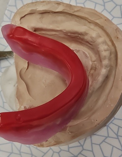 Biteblocks For Jaw Relation Before Complete Denture