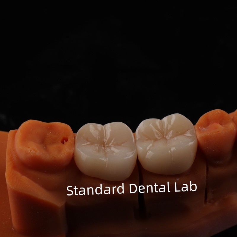 Full Contour Zirconia Crown Translucency 3D PRO No Porcelian Overlay Standard Dental Lab
