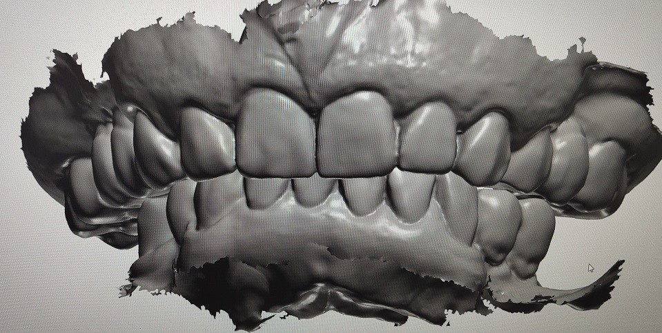 3D Digital Mock Up Teeth Other Dental Products