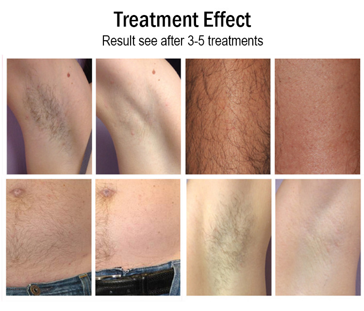 Portable Hair Removal Laser Machine With ABS Case - Effective Solution