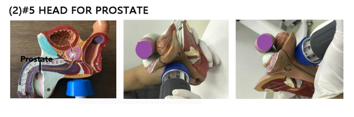 Extracorporeal Focused Shockwave Therapy Machine Portable For Pain Removal