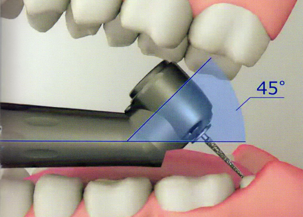 LED 45 Degree Fiber Optic Surgical High Speed Dental Handpiece