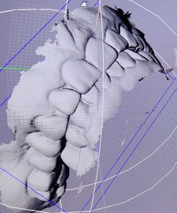 CAD Digital Impression Of Oral Scanning STL Files