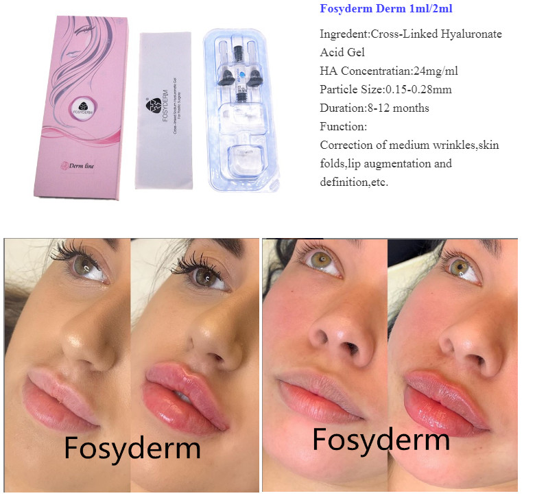 Beauty Care Fosyderm Hyaluronic Acid Dermal Filler For Lip Nose Chin And Cheek