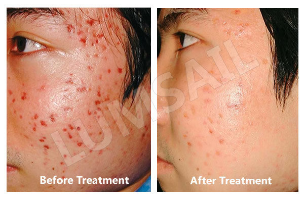 PDT LED Red Light Therapy For Skin / Wrinkles , Red Light Facial Therapy Devices