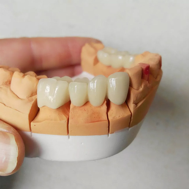 Color Stable PFM Dental Crown Acid And Alkali Resistance Not Easy To Wear