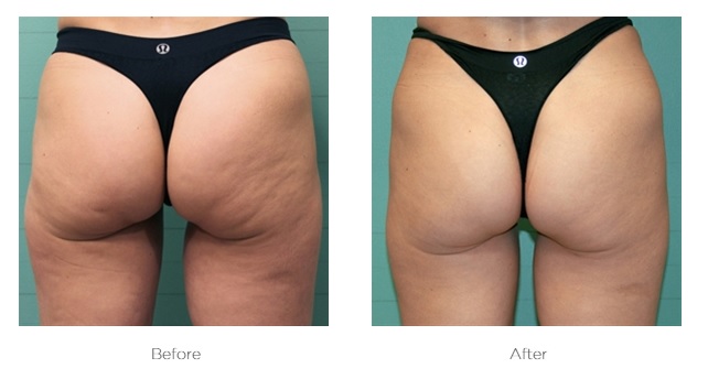 Elite Ultra 360_Before_and_After_Buttocks