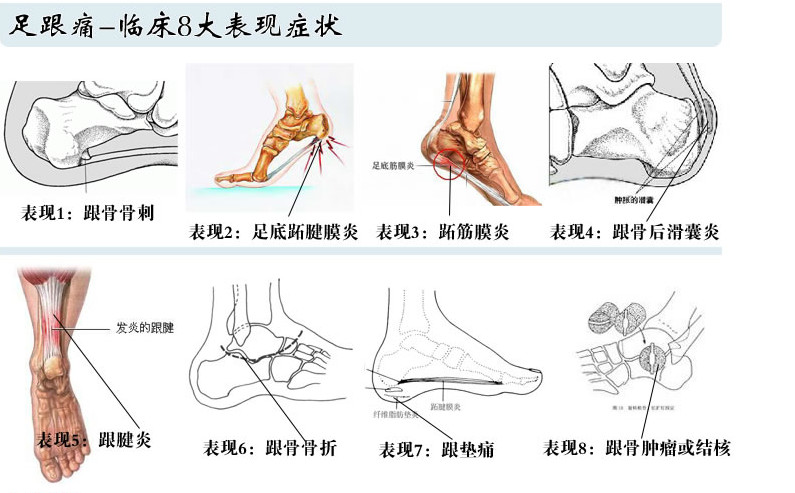 Heel Spur Pain Relief Patch Herbal Calcaneal Spur Rapid Heel Pain Relief Patch Foot Care Treatment Plaster