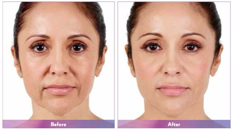 Voluma Hyaluronic Acid Fosyderm Dermal Filler Injection 24mg/Ml