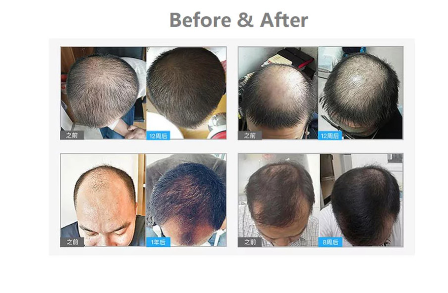 650nm Portable LLLT Laser Diodes Hair Regrowth Cap For Home Use