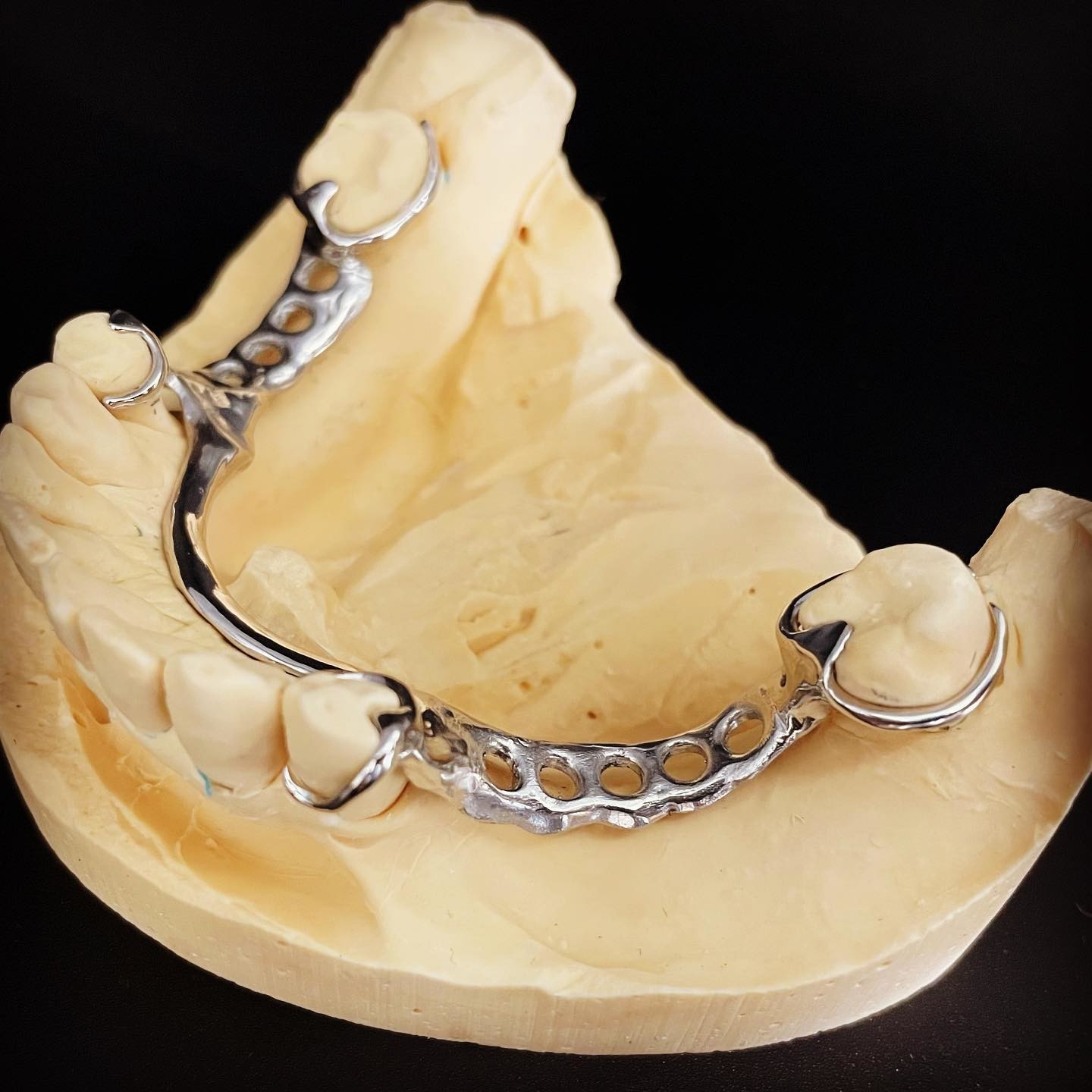 Fast and Cast Framework Co-Cr Metal Partial Denture Framework for Dental Professionals