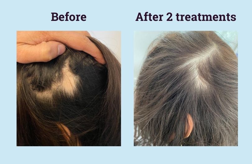 Original Anti Hair Loss Injection Treatment Hair Regrowth Essence Alopecia Areata Mesotherapy Serum For Hair