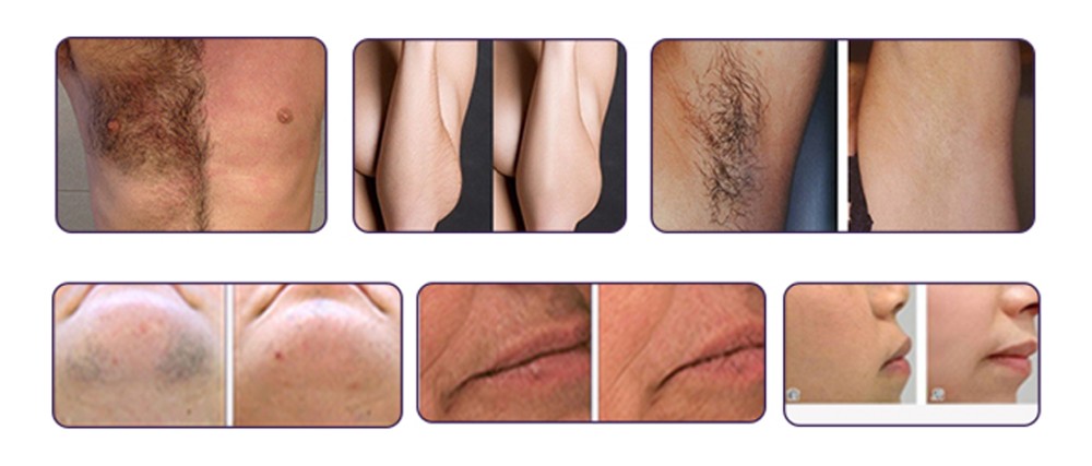 Large Spot Size Laser Hair Removal Equipment Professional High Powerful