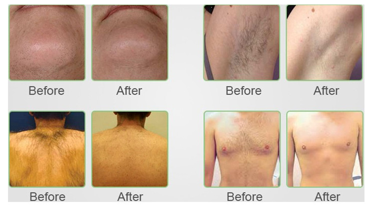 1Hz - 10Hz Alexandrite Laser Hair Removal Machine SDL-C 1300VA