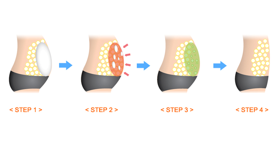 Fat Removal Treatments By Injecting HYAMELY Lipolytic Solution 10Ml 10 Vials