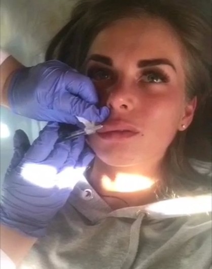 Hyaluronic Acid Dermal Filler For Lips Fullness , 1ml HA Lip Augmentation Fillers