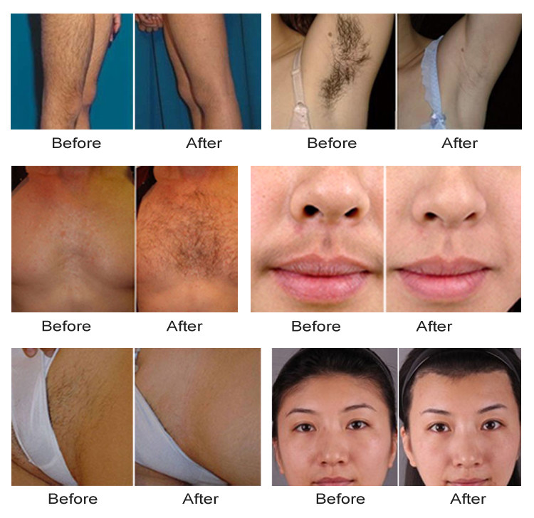CE Professional Soprano 808nm Diode Laser Epilator , 808nm Diode Laser , 808nm Diode Laser Hair Removal