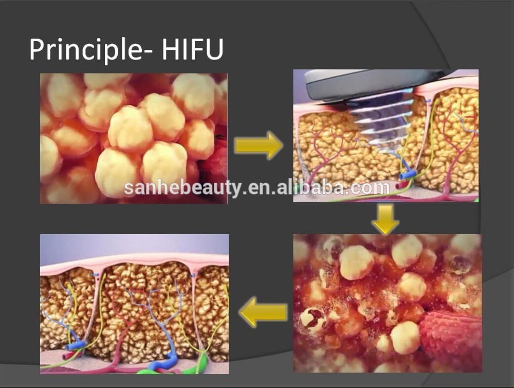 *New product looking for distributor! Hifu slimming machine