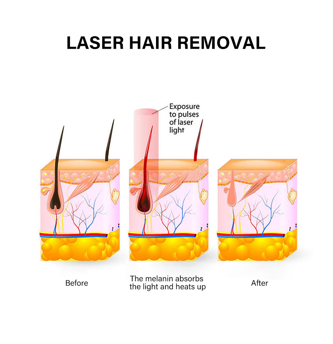 Beauty Salon Fiber Laser Hair Removal Machine 300W 500W Stationary Style