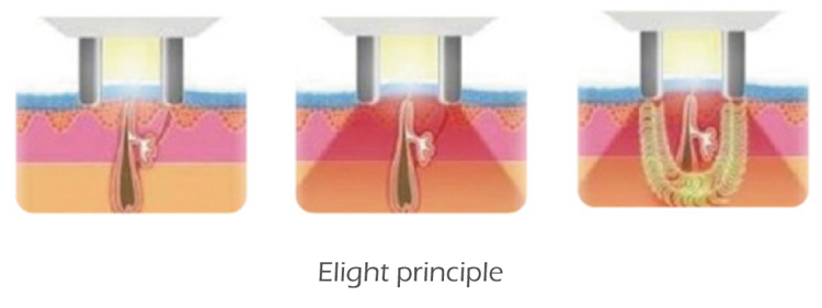 The Professional Shr Best Hair Removal Ipl Elight Opt Laser Machine