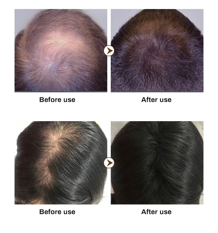 Best Selling Hair Growth Shampoo for Thinning Hair Loss for Women and Men Thicker Longer Hair