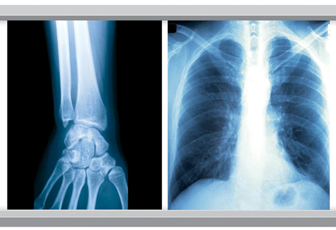 Blue White Base Medical X Ray Film 35x43CM 10x12 Inch X Ray Dry Film For Fuji Printer 1