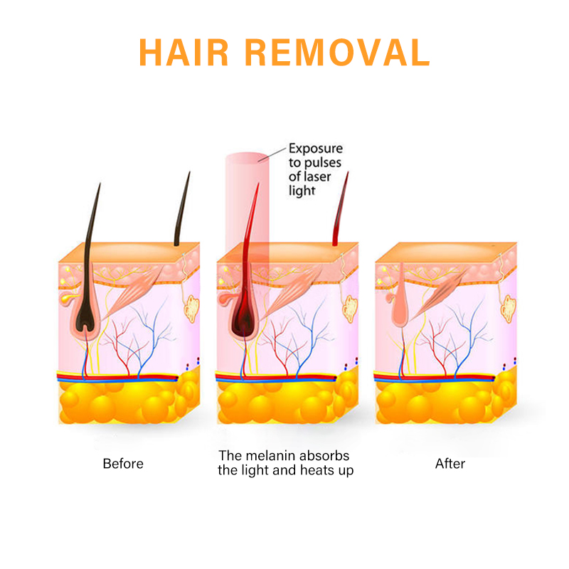 Professional laser machine hair removal depilation alexandrite 808 diode laser hair removal