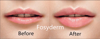 Transparent Dermal Lip Fillers For Lip Plump