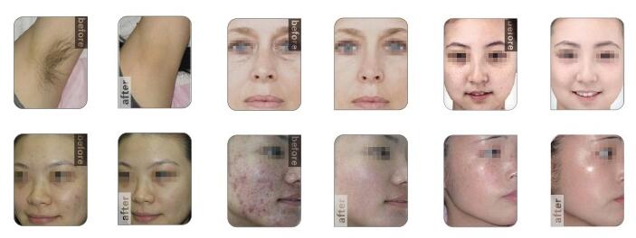 beauty equipment multifunctional 3 in 1 Permanent e-light xenon lamp elight shr lase ipl hair removal machine