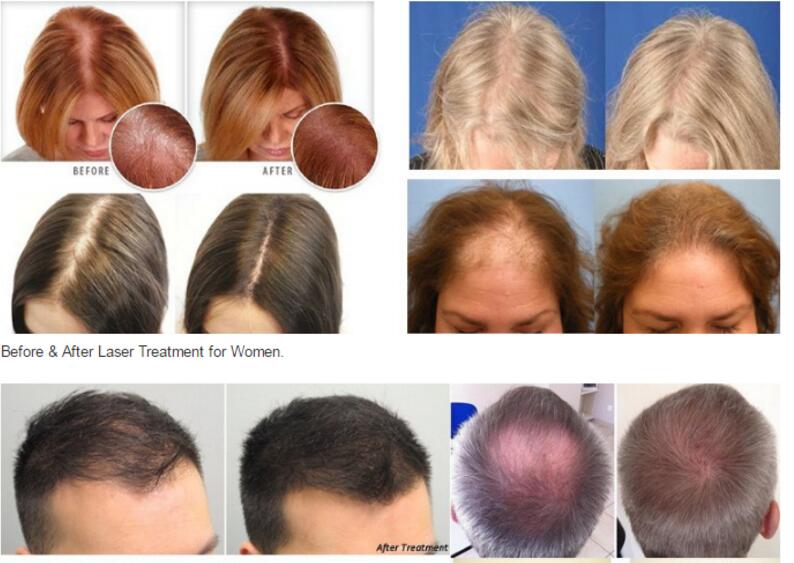 Infrared Hair Regrowth Laser Machine , 650nm Diode Laser Hair Fall Treatment Machine