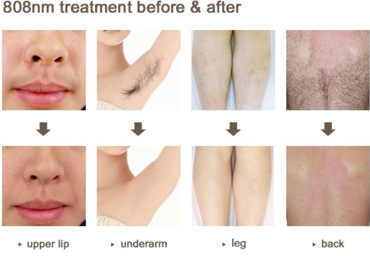 808 Laser Beauty Equipment Diode Painless Fast Hair Removal Machine