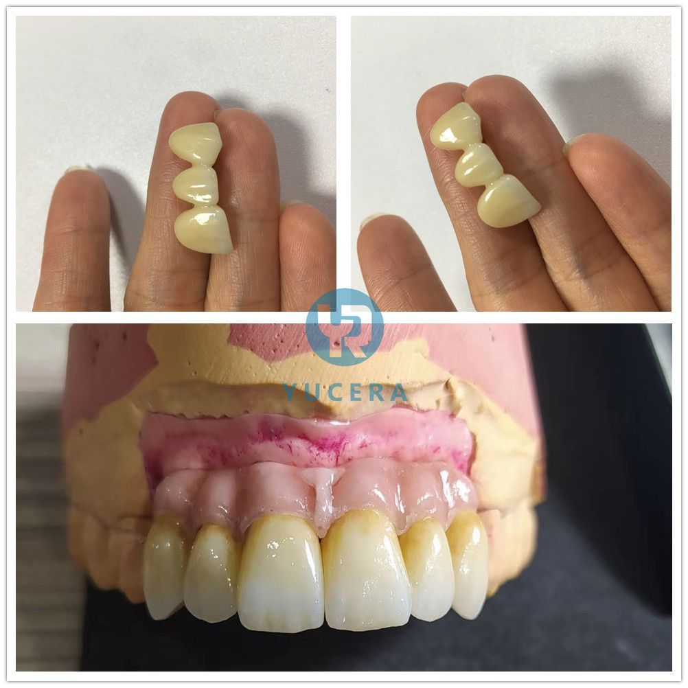 Vita 16 Color 1200Mpa Dental Zirconia Block High MPA For Bridge