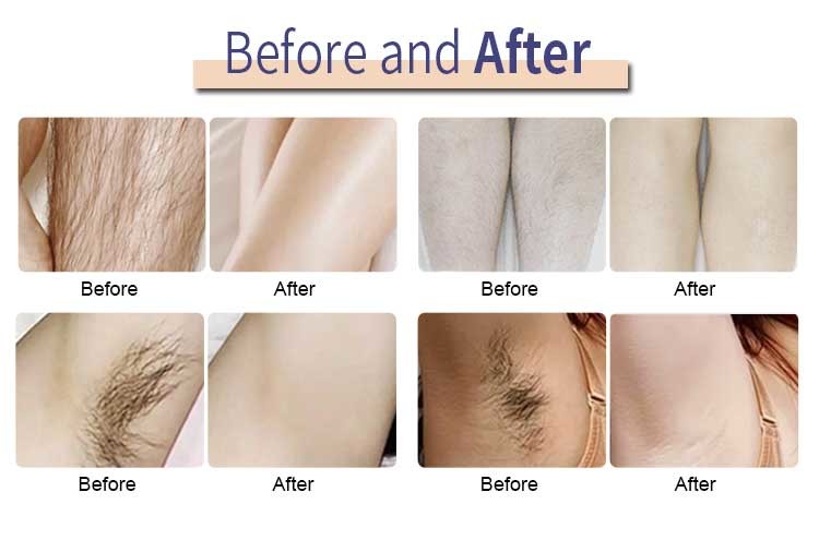 500W 808nm Portable Diode Laser Hair Removal Machine 3 Waves