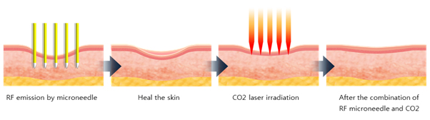 promotion promotion promotion skin rejuvenation fractional rf microneedle machine