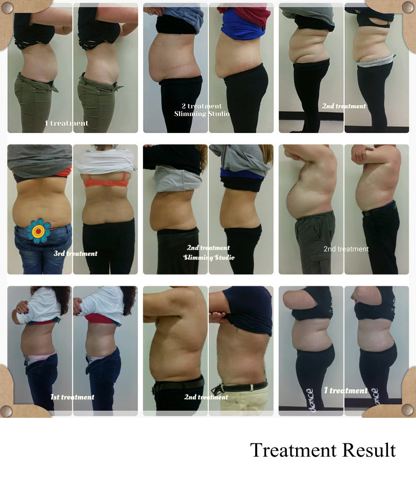 2016 the best cryotherapy machine for weight loss and body slimming