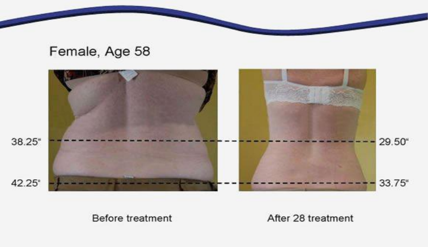6 In 1 RF Lipolaser 80k Cavitation Weight Loss Rf 80k Cavitation Ultrasound Slimming Machine