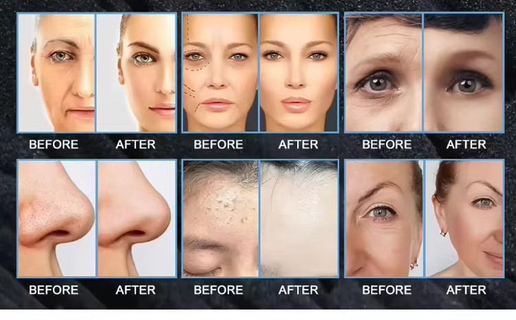 14in1 Microdermabrasion Aqua Peeling Hydra Water Face Cleansing Machine