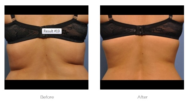 Elite Ultra 360_Before_and_After_Love_Handles