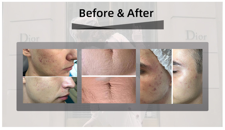 Scar Removal Oem Lasertell Co2 Laser Machine For Skin