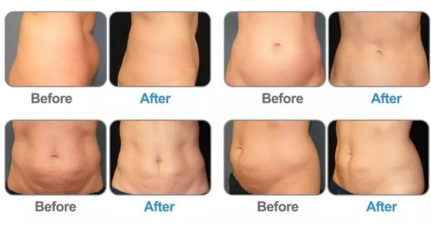 Crolipolysis (1).png