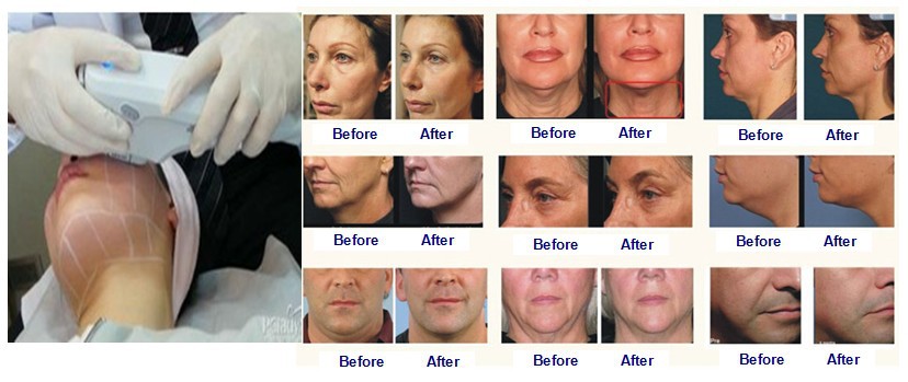 New high intensity focused sound & skin tightening and wrinkle removal HIFU
