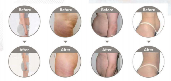 4 Handles 1000w Cryolipolysis Slimming Machine / 1-15J Vacuum Slimming Machine