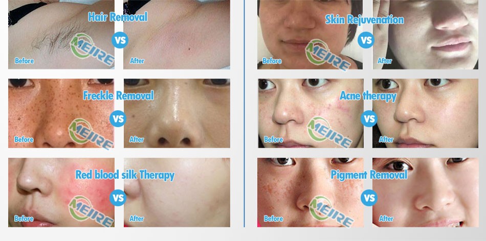 Portable Opt Shr Ipl Machine One Headpiece 8mm * 40mm Light Spot