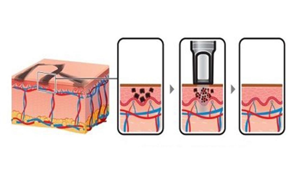 Pigment Reduction IPL RF Beauty Equipment 2500w Output Power 4 - 8mm YAG Spot Diameter