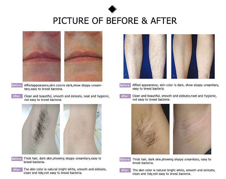 professional waterproof epl blvk dark silk 999999 byehair permenant 808 nd yag dimond diod laser hair remover for ladies